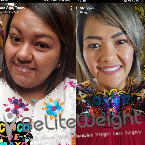 Weight Loss Surgery Before And After Linda G - 2 Year Update*